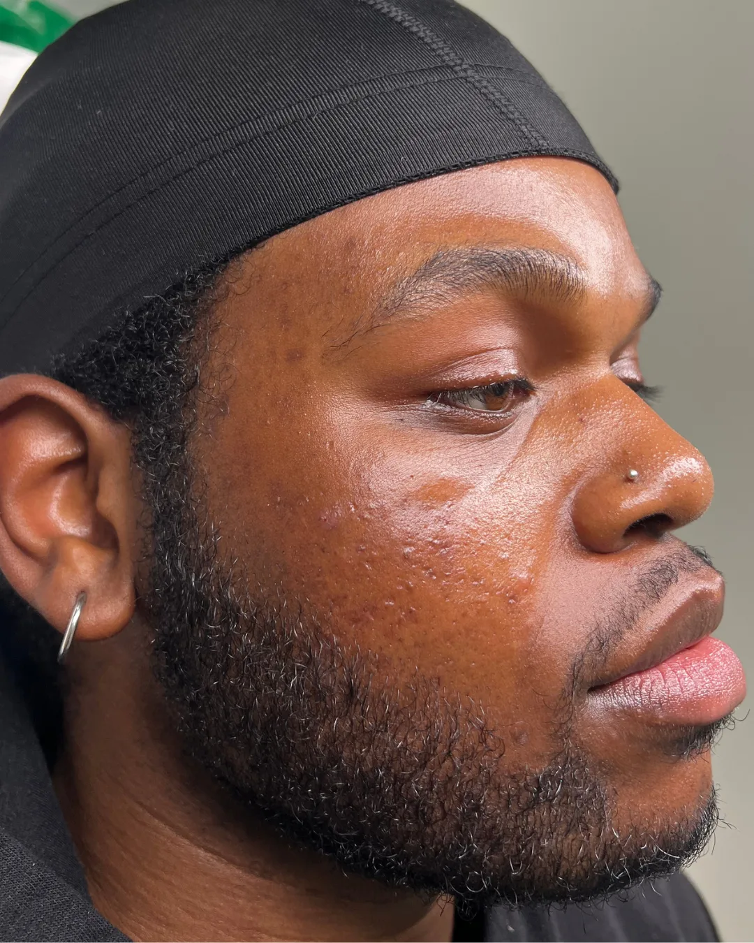 chemical peel result